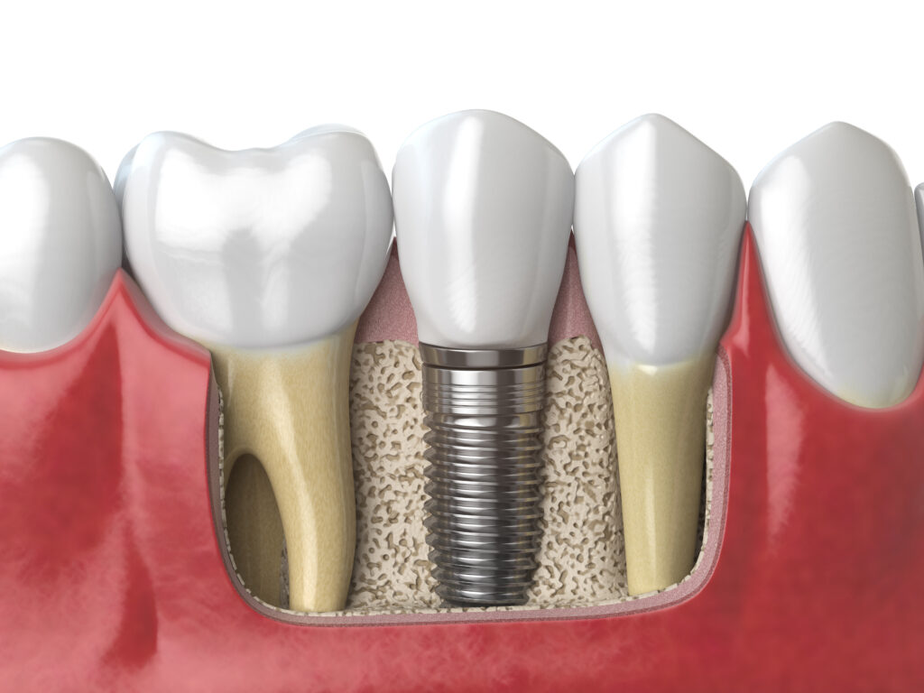 Dental Implants North Raleigh