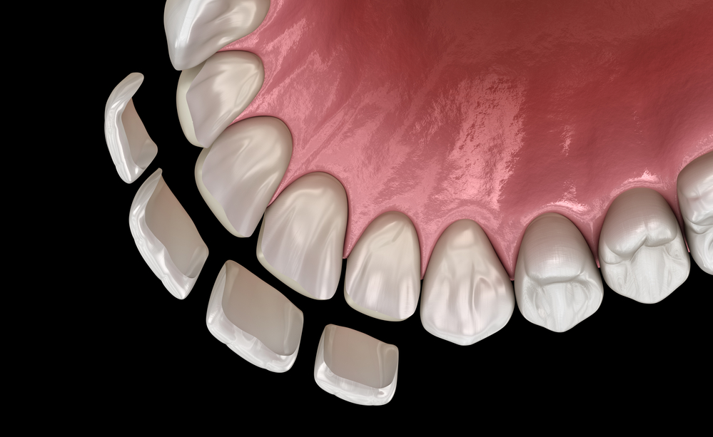 types of Dental Veneers