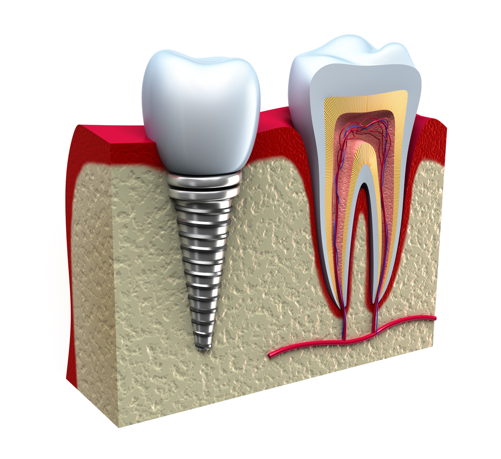 how do dental implants work